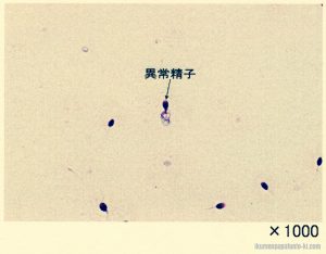 精液検査報告で異常精子数が多い？